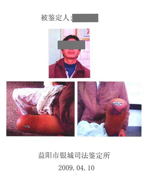 長(zhǎng)沙上下肢假肢銷售,截癱支器哪里好,德誠(chéng)精博義肢矯形康復(fù)器材有限公司
